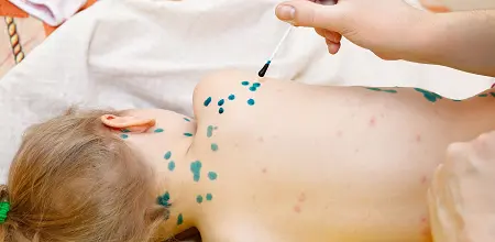 Windpocken sind hochansteckend!